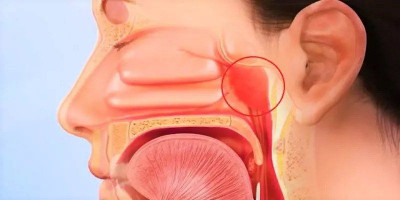 Mengenal Adenoiditis, Gejala, Penyebab, dan Cara Mengobati